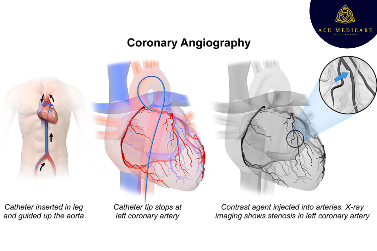 Understanding Angiography: A Comprehensive Guide
